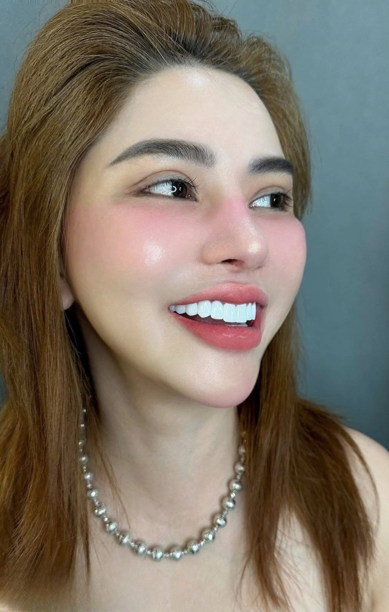 Ảnh khách hàng bọc răng sứ trắng trong tự nhiên – hình 11