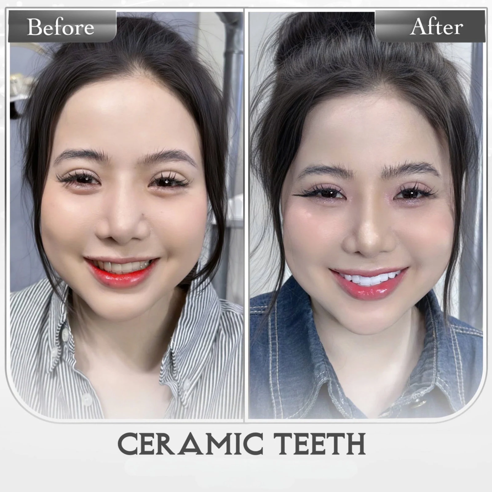 Hình ảnh nụ cười trước và sau do Q Dentist cung cấp – bộ ảnh 05
