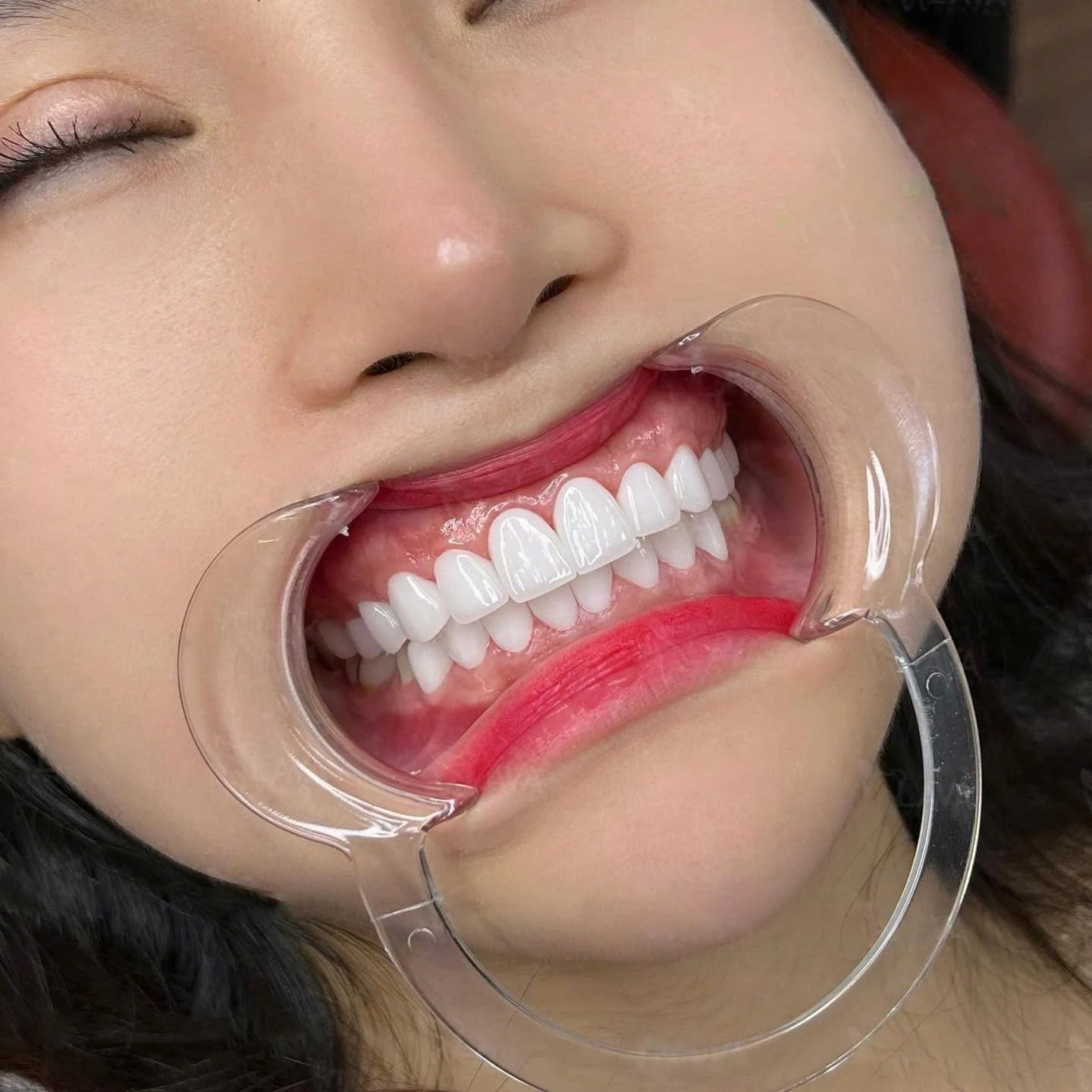 Cận cảnh răng sứ – hình 15