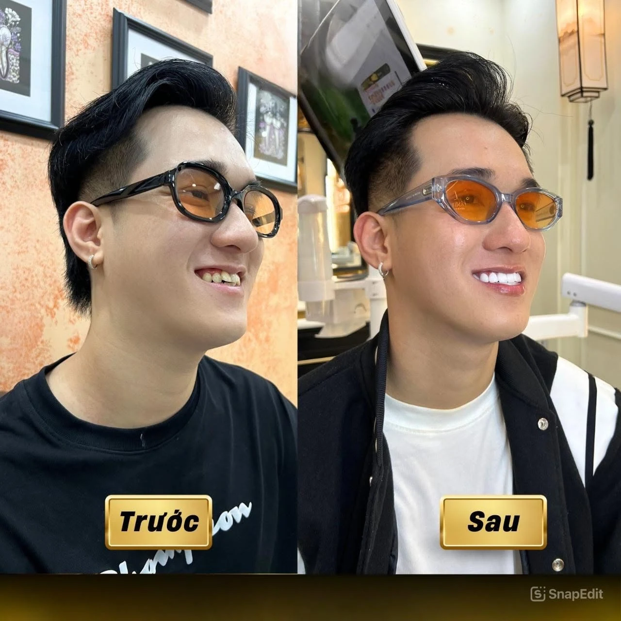 Hình ảnh nụ cười trước và sau do Q Dentist cung cấp – bộ ảnh 04