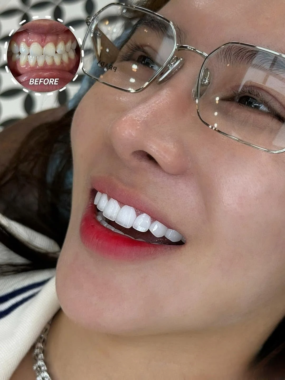 Hình ảnh trước và sau bọc răng sứ – hình 24