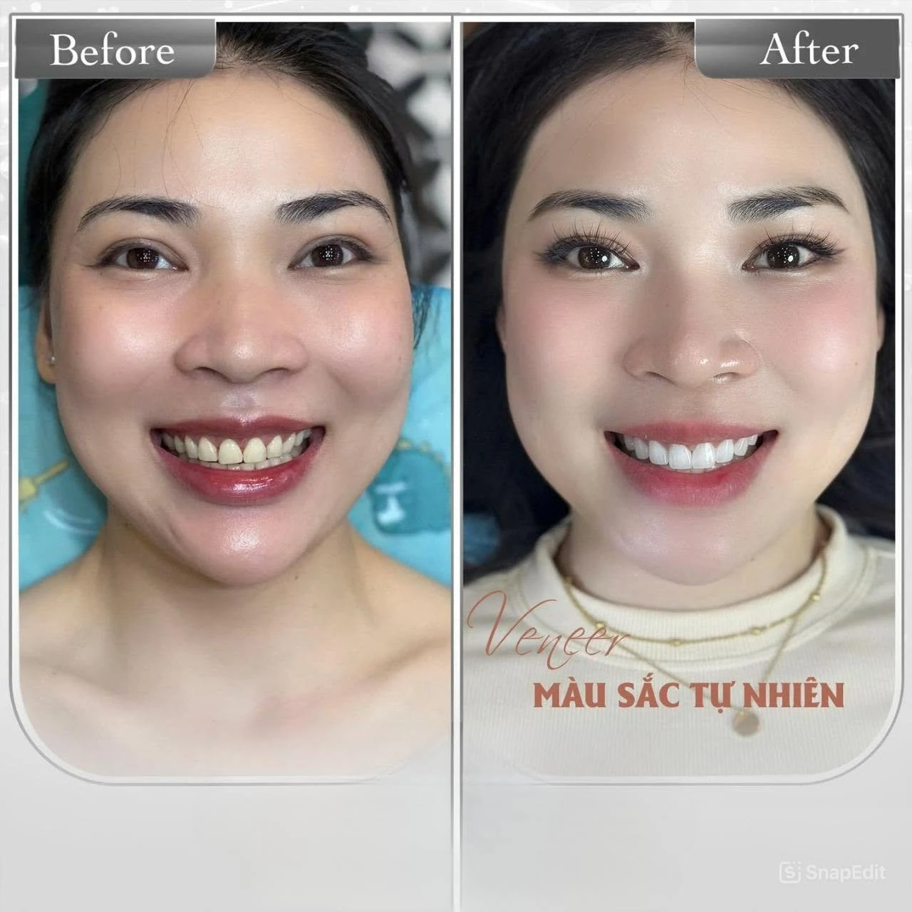 Hình ảnh nụ cười trước và sau do Q Dentist cung cấp – bộ ảnh 03