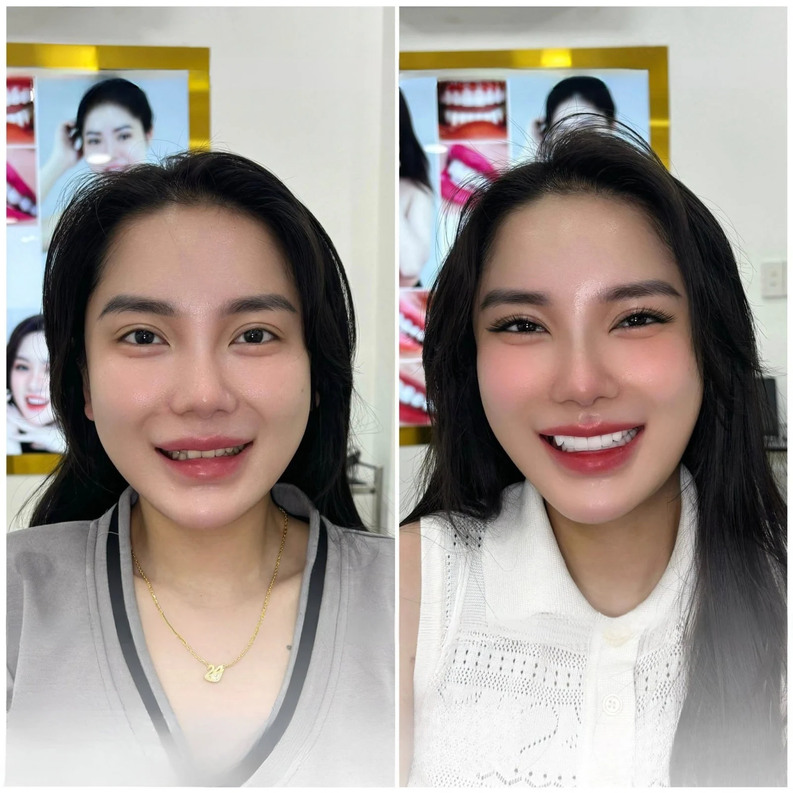 Hình ảnh nụ cười trước và sau do Q Dentist cung cấp – bộ ảnh 02