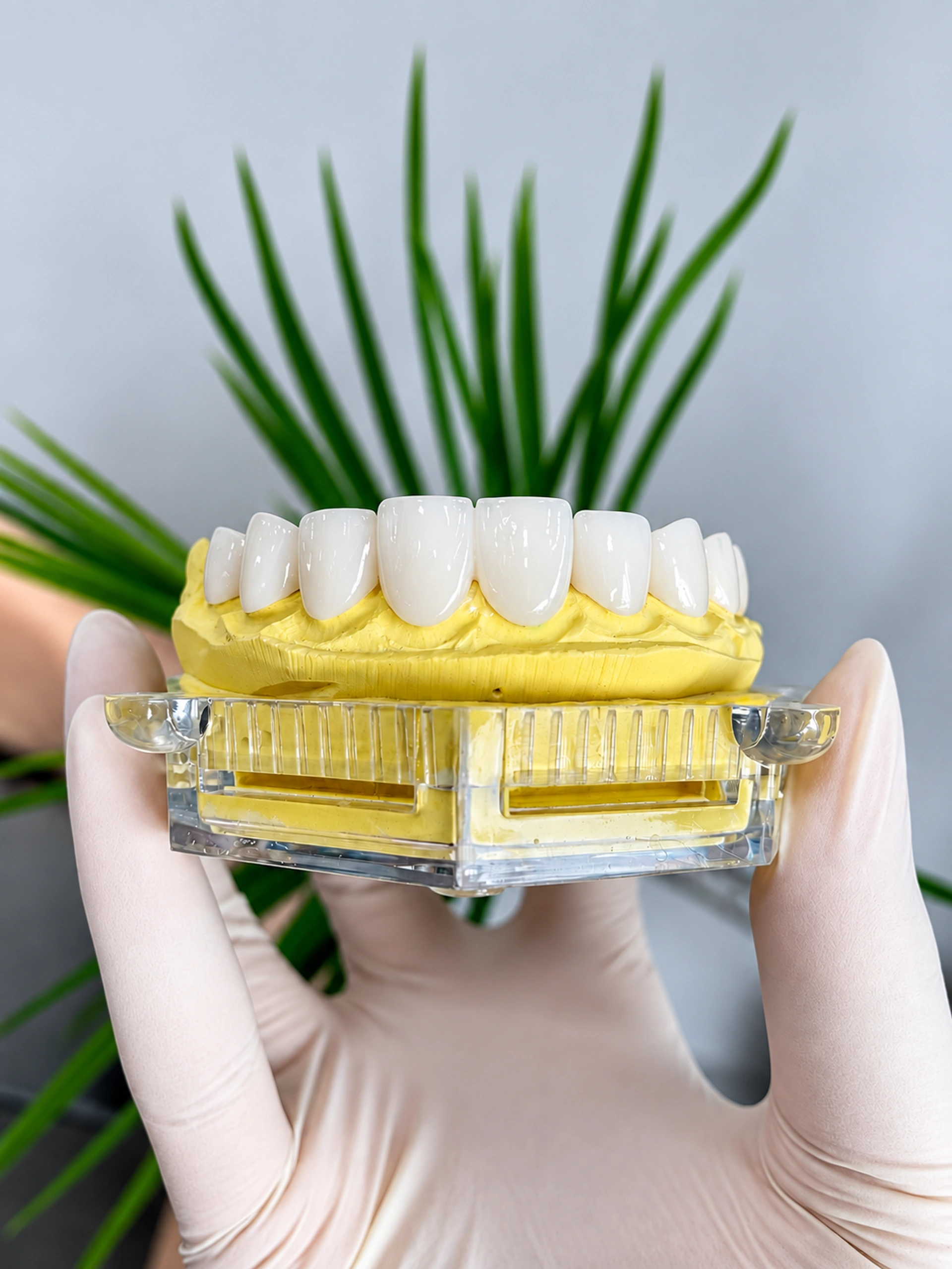 Dán sứ Veneer — hình ảnh tại Q Dentist